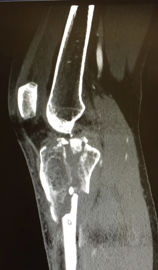 x-ray of tibia fracture
