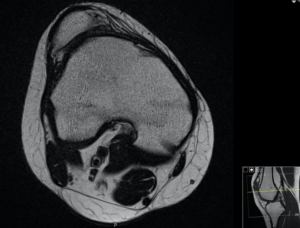 x-ray of knee cap